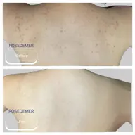 モニター募集🪡背中半分<7日間改善チャレンジ>剥離有ピーリング◎1週間で背中つるつる🫧ニキビ跡/ニキビ/色素沈着