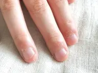 撮影モデル募集中　深爪の方、むしり爪、噛み爪に方、限定　アクリル深爪育成