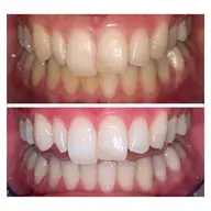 【初回限定・白さを極める】4月限定の特別価格 プレミアムホワイトニング〈合計 60分照射 2 来店コース〉❣