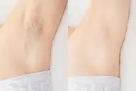 【男女共通】ワキ脱毛