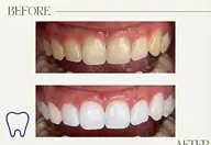 【当日予約OK】だれにも見られず半個室で施術できる✨️🌸ホワイトニング体験2200円！食事制限なし✨️