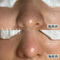 【29歳以下の方限定】いちご鼻バイバイ🍓ツルツル美肌になる毛穴ケア50分【ミニモ特別価格】カウンセリング込み80分