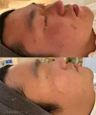 《組み合わせ人気No1!》剥離なしハーブピーリング♡再生鎮静パック付 ¥17500→¥14500