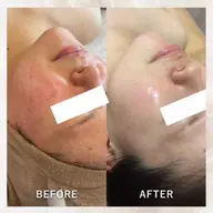 【牛田店限定】SR光フェイシャル⭐︎シミ/そばかす/ニキビ/シワ・赤ら顔に特化！お悩みが少ない方にオススメ