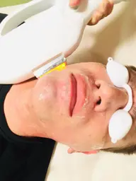 メンズひげ脱毛