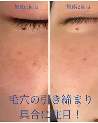 毛穴の黒ずみを徹底改善🙌毛穴洗浄、引き締めコース🧚✨毛穴の悩みに寄り添います!
