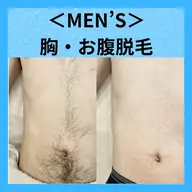 【メンズ脱毛】胸+お腹脱毛 ¥2,200