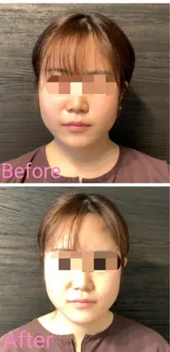 美容鍼灸トライアル