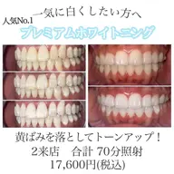 【人気No.１】プレミアムホワイトニング 2来店合計70分 輝く白い歯へ🦷✨