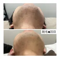 【メンズ】ヒゲ脱毛1パーツ体験