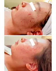 【初回☆赤いニキビ徹底ケア】ポツポツできにくい肌に! ニキビ肌徹底ケアフェイシャル