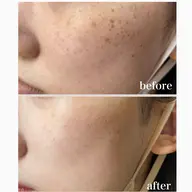 シミケア　（10ショット）