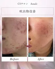 肌質改善✨敏感肌コース（赤み・吹き出物・アトピー肌）