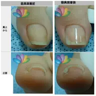 初回限定巻き爪補正【軽度】プリパレーション無料&爪の長さ整え無料サービス