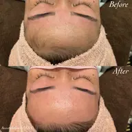 フルフェイスワックス脱毛