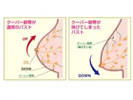 産後・授乳後の下垂したバストを改善します