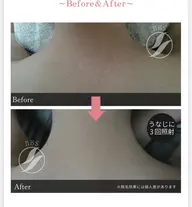 顔と襟足　夏までに襟美人目指しませんか？