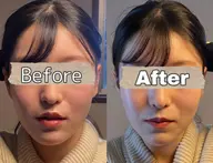 痩身マシン　10000shot