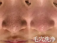 【新規/花粉や皮脂対策で透明肌へ】全顔3D毛穴洗浄¥5500