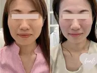 【平日15時迄限定】リフトアップ機械＆もちもち石膏orハリ艶or美白パック¥18000→