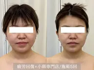 【minimo限定★】眠れる小顔コルギ＋炭酸ドライヘッドスパ(80分)