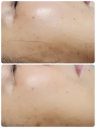 💎【スペシャルケア】集中美白ハーブピーリング