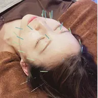 【初回限定】美容鍼
