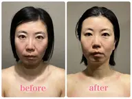 小顔100minコース1,500円体験👑【¥24,200▶︎¥1500】/イベント期間内のみ利用可能、口コミ必須