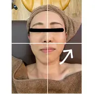 茨城県では珍しい顔用痩身！リフトアップ完全特化！小顔サーマルフラクショナルRF(60分)カウンセリング込み