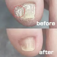 副爪（ふくそう）ケア　1趾