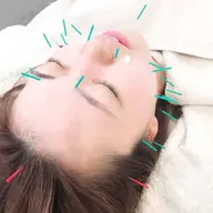 肌荒れ改善・リフトアップ効果⭐️美容鍼のみ