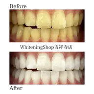 【セルフホワイトニング】当日クーポン★45分照射！初回お試し限定！