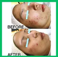 《人気No.1》【当日限定🈹】《ニキビ・ニキビ跡》ニキビケア2回体験✨(19歳以下不可)　[大阪城北詰駅/京橋駅]