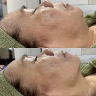 -15歳の肌を！たるみやしわ、ハリのない肌からさよなら！プラズマフェイシャル(顔・首)