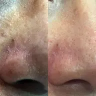 周年特別🈹　【Tゾーン毛穴洗浄＆顔脱毛＆美白パック付】