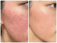 ミニモ価格✨リベルハーブピーリング➕まつ毛パーマ