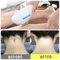 初回🧡特許取得マシン🧖🏻‍♀️　全身脱毛VIO込【襟足、お顔以外 】