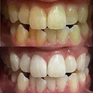 【期間限定】ホワイトニング20分照射🦷✨