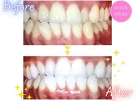 【4月限定サービスクーポン】医療提携セルフホワイトニング(9 分×2 回)1回¥3980→