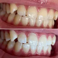 歯を自然な白さに!🦷✨【照射時間15分×2回の30分】メンズも大歓迎♪口コミ協力してくれる方歓迎♪女性・男性🆗