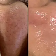 【今だけ】毛穴・くすみリセット体験  毛穴洗浄ポセイドン×ヒト幹細胞美容液✨洗うたびに透き通る素肌へ