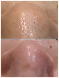 【鼻の毛穴洗浄】毛穴の詰まり/いちご鼻/毛穴の開き/ごわつき