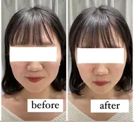 【リフトアップ／即効小顔】3D超音波リフト☆7500ショット😊