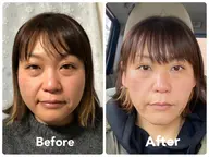 【ほうれい線改善♡ほうれい線でため息してる大人女子におすすめ】だんだん薄くなって嬉しい小顔矯正45分🎉