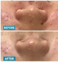 《ミニモ学割》ニキビ撲滅フェイシャル✨繰り返すニキビ、爆弾ニキビ💣お悩みではないですか？