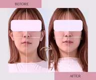 《当日予約限定》加工も整形も不要💓中顔面短縮/リフトUP/導入店希少マシンでエラ張りも解消✨頭蓋骨小顔矯正70分