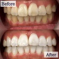 【💎効果実感💎】8分照射×4回✨効果を実感してスタートしたい方にオススメ❣セルフホワイトニングで白い歯に🦷