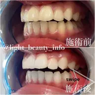 【初回限定プラン✨】強力集中ケア‼️ごっそり着色抜けます🤩ハイパワーホワイトニング40分照射