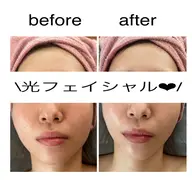 【ハリツヤUP小顔に💛】光フェイシャル(顔、デコルテ)+保湿パック