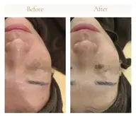 【お顔全体を綺麗にしたい方に!】お得な3パーツ洗浄✨(鼻+顎+おでこ/鼻+頬+顎/頬+おでこ+顎などの部位自由!)